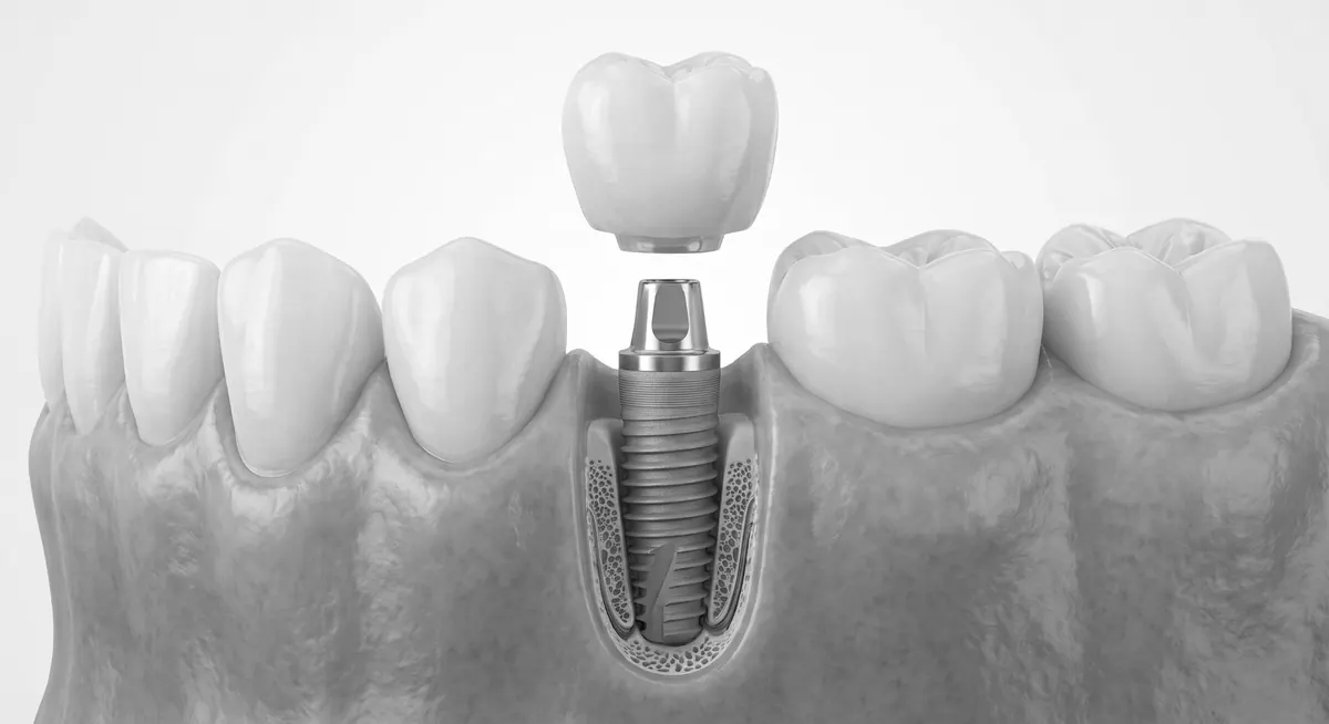 Implante dental en Bioestética Dental